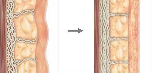 xoa-nhan-nang-co-ultherapy