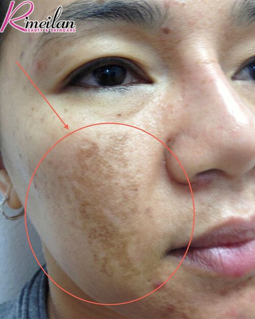 Bị nám sâu có chữa được không?