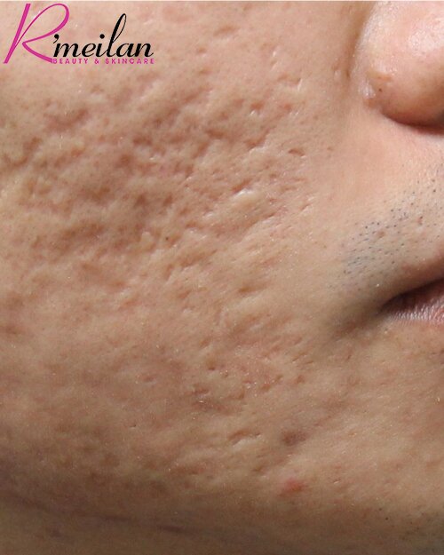 Bị sẹo rỗ lâu năm có chữa được không?