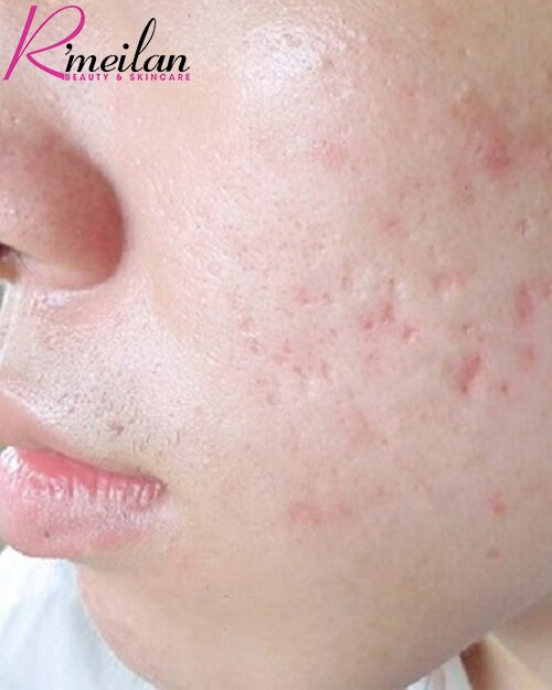 Cách điều trị sẹo rỗ cho nam giới hiệu quả hiện nay?