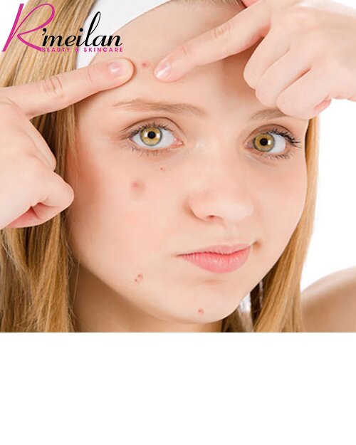 Có nên điều trị mụn ở thẩm mỹ viện hay không?