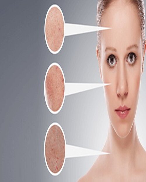 Điều trị mụn ẩn dưới da bằng cách nào?