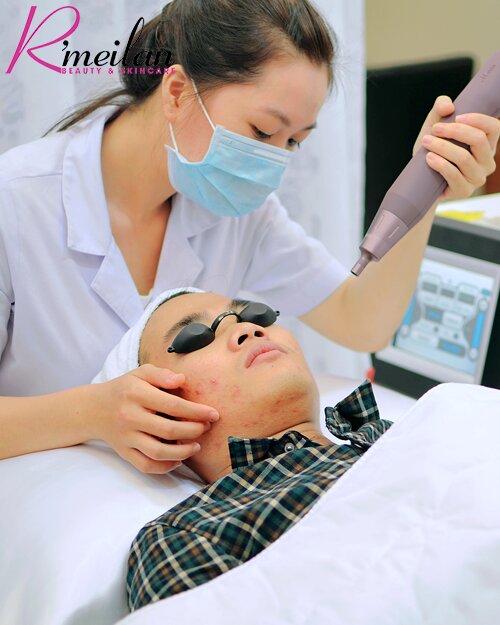 Điều trị mụn bằng Laser có tốt không?