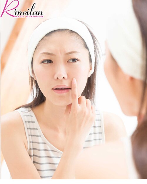 Cách điều trị và ngăn ngừa mụn ở tuổi dậy thì sao cho đúng?