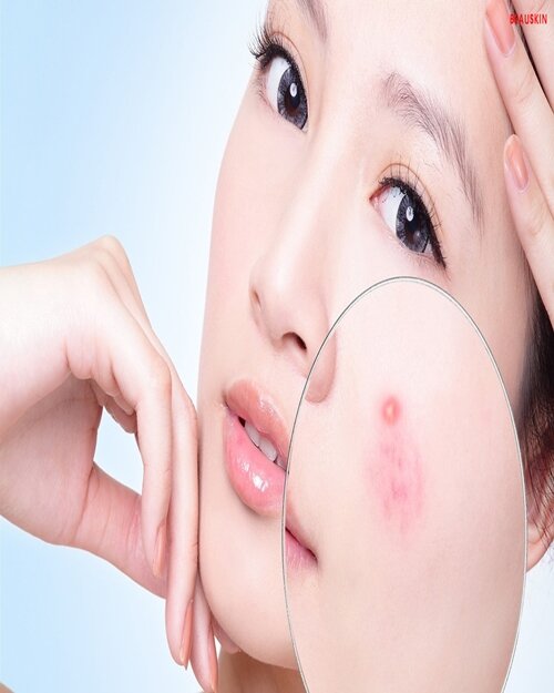 Trị mụn trứng cá tại Bệnh viện da liễu hay Thẩm mỹ viện?