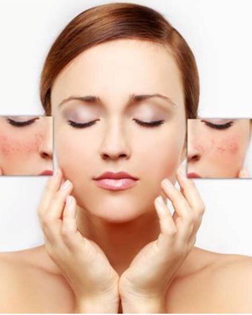 Điều trị nám bằng laser công nghệ cao có gây đau đớn không?