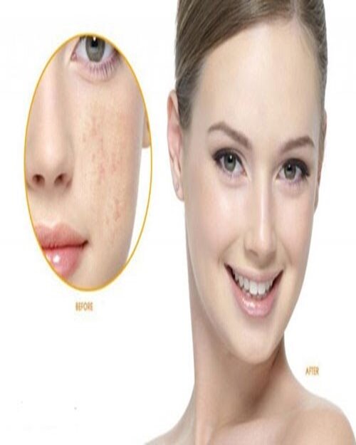 Điều trị nám bằng laser có thực sự hiệu quả?