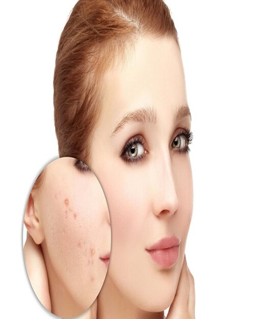 Điều trị sẹo lõm có đau không? Có hiệu quả không?