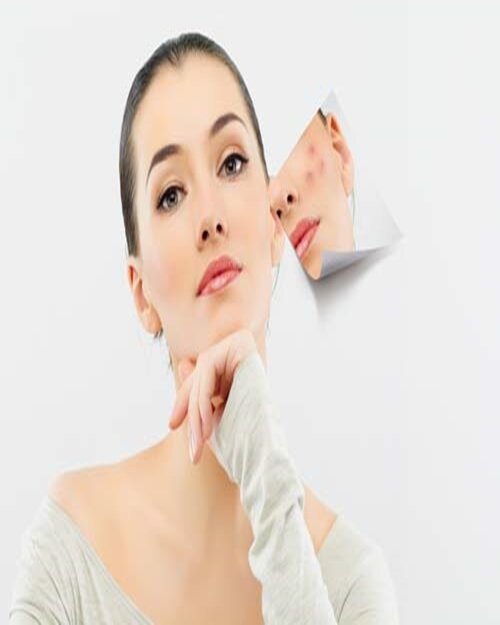 Sẹo rỗ do mụn điều trị bằng kem trị sẹo hay laser công nghệ cao?
