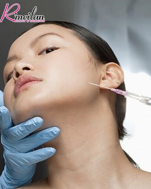 Điều trị sẹo rỗ bằng PRP có thực sự tốt?