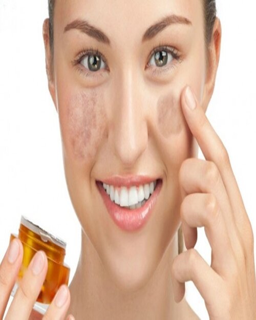 Nám da do lạm dụng mỹ phẩm có chữa được không?