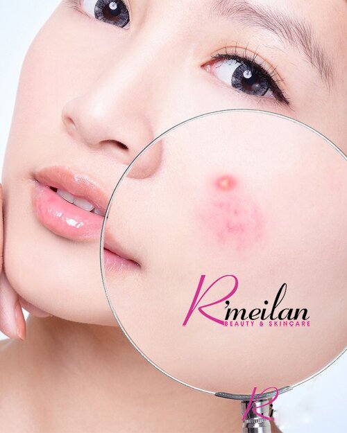  Nguyên nhân và cách phòng ngừa mụn trứng cá hiệu quả
