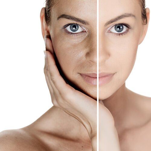 Những trường hợp không nên điều trị nám bằng Laser