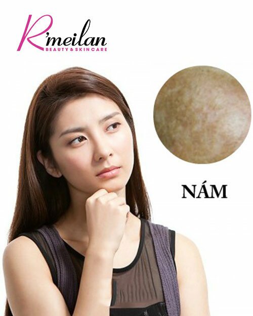 Cách trị nám da tận gốc do di truyền