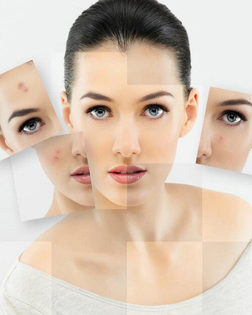 Trị sẹo bằng Laser siêu vi điểm CO2 có đau không?